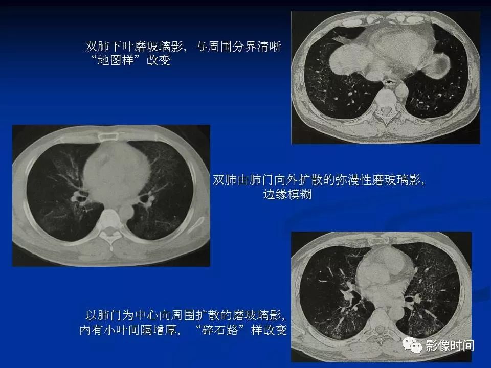 【PPT】肺内磨玻璃影的CT诊断