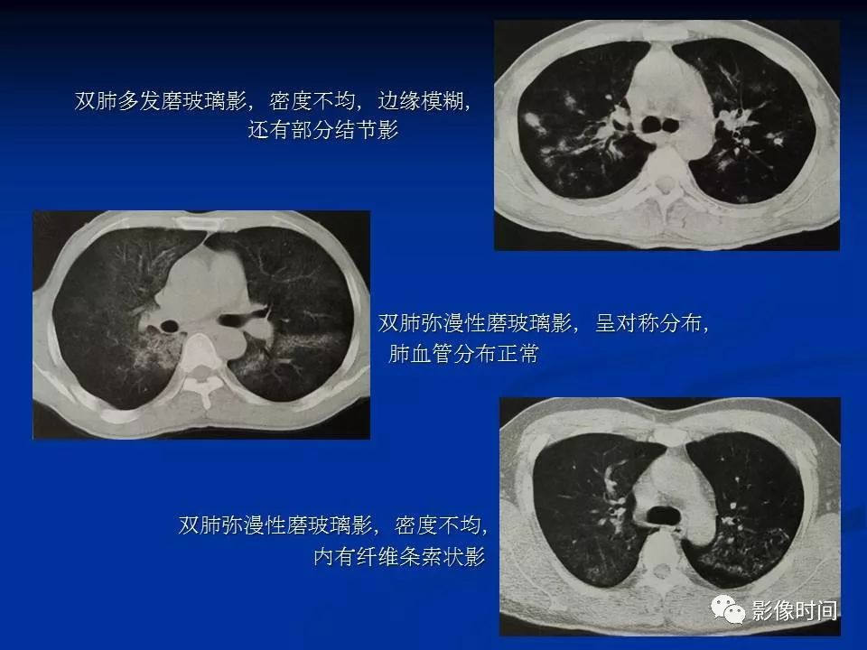 【PPT】肺内磨玻璃影的CT诊断