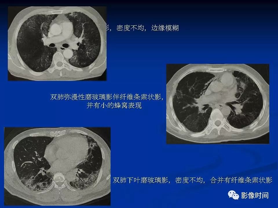 【PPT】肺内磨玻璃影的CT诊断