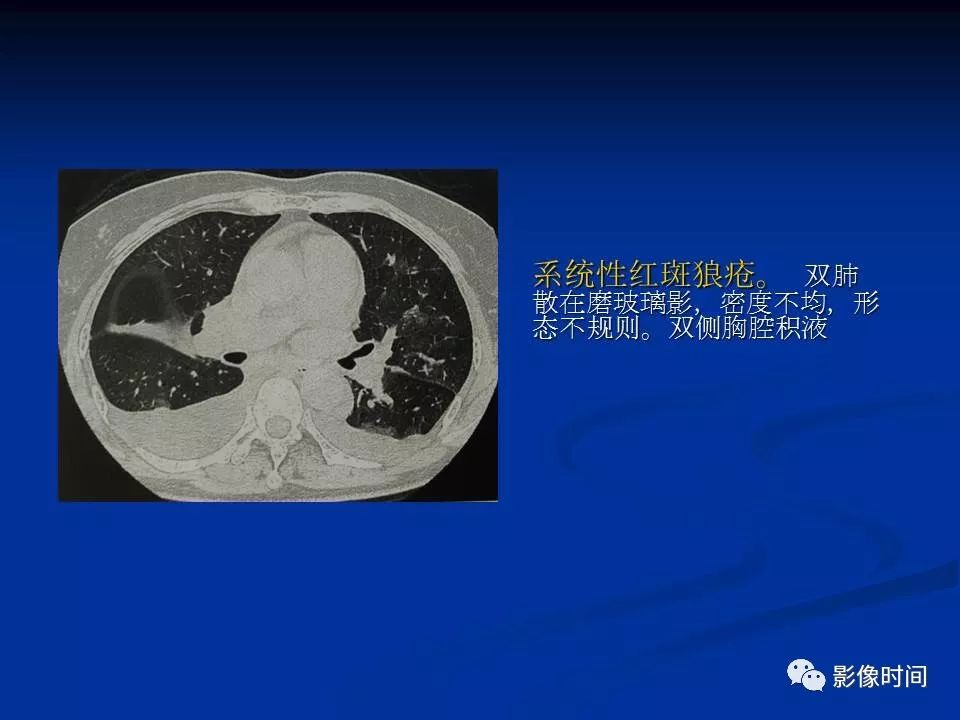 【PPT】肺内磨玻璃影的CT诊断