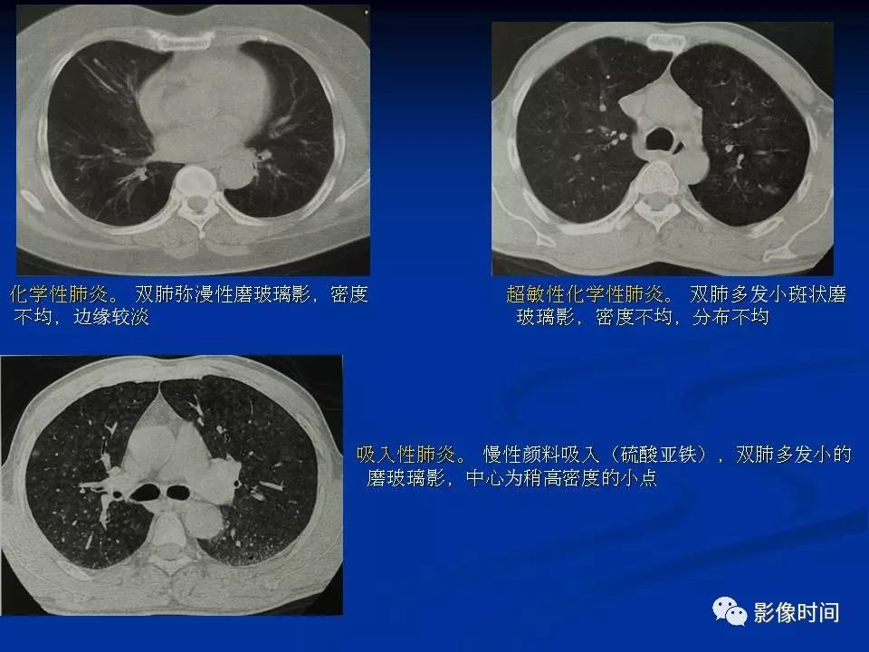 【PPT】肺内磨玻璃影的CT诊断