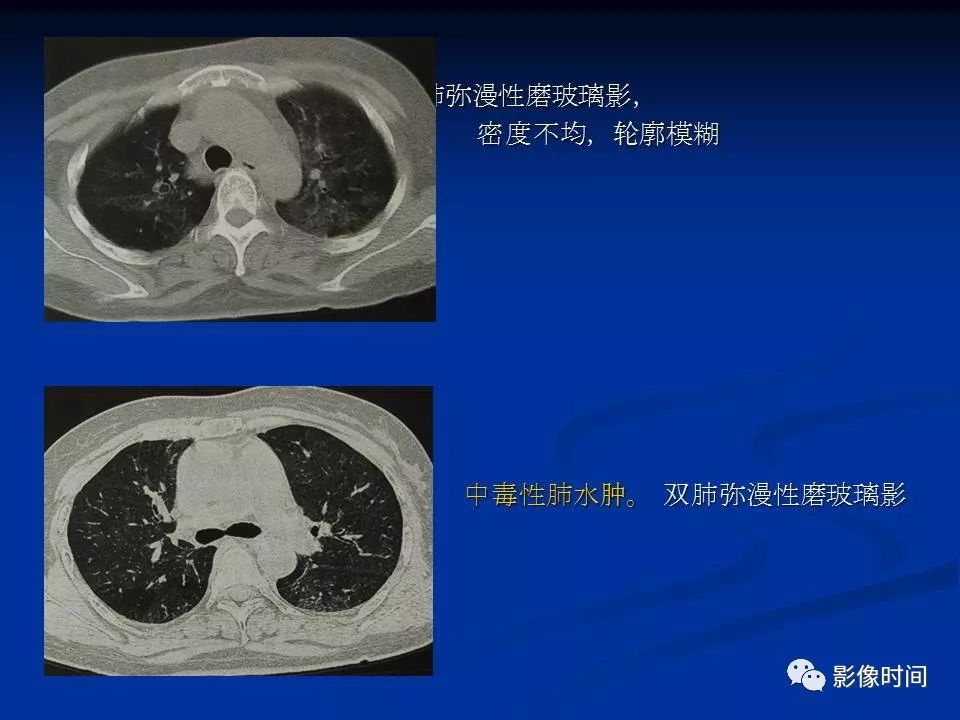 【PPT】肺内磨玻璃影的CT诊断