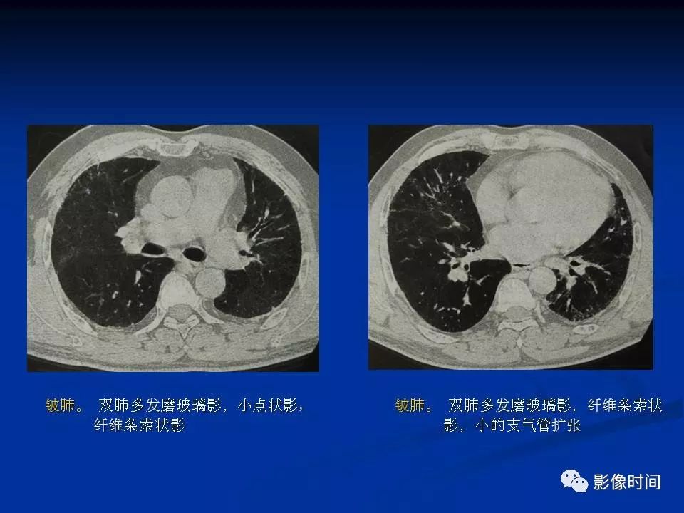 【PPT】肺内磨玻璃影的CT诊断