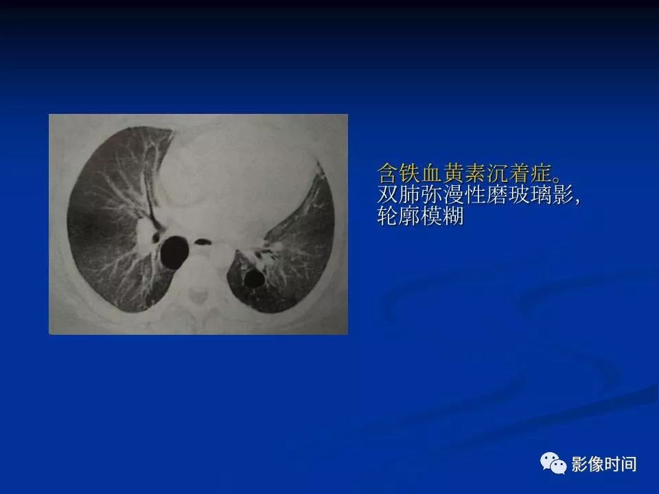 【PPT】肺内磨玻璃影的CT诊断