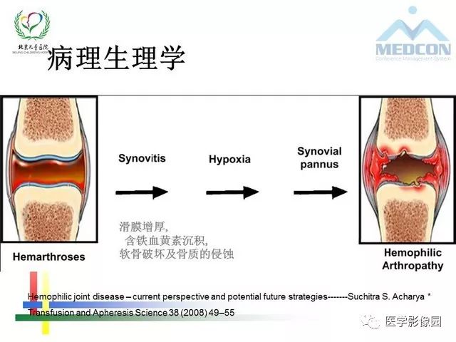 【PPT】儿童血友病性骨关节病的影像评估与策略
