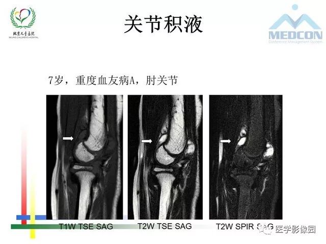 【PPT】儿童血友病性骨关节病的影像评估与策略