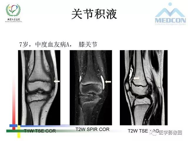 【PPT】儿童血友病性骨关节病的影像评估与策略