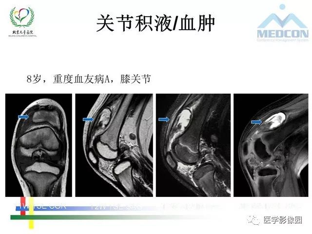 【PPT】儿童血友病性骨关节病的影像评估与策略
