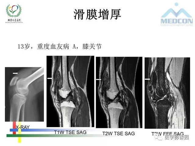 【PPT】儿童血友病性骨关节病的影像评估与策略