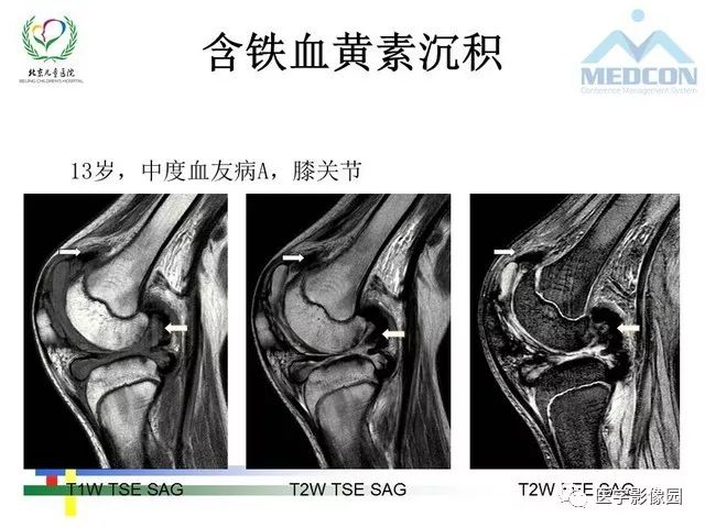 【PPT】儿童血友病性骨关节病的影像评估与策略