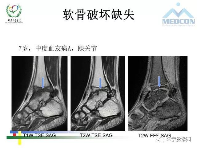 【PPT】儿童血友病性骨关节病的影像评估与策略