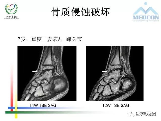 【PPT】儿童血友病性骨关节病的影像评估与策略