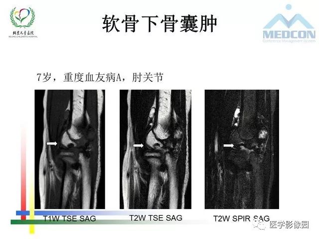 【PPT】儿童血友病性骨关节病的影像评估与策略