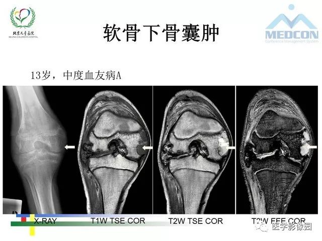 【PPT】儿童血友病性骨关节病的影像评估与策略