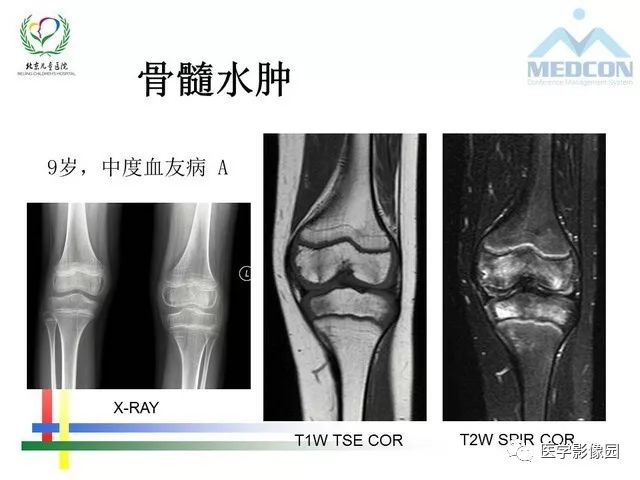 【PPT】儿童血友病性骨关节病的影像评估与策略