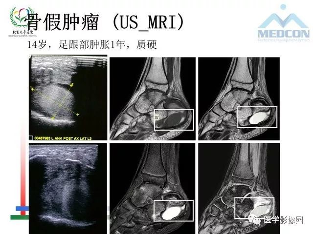 【PPT】儿童血友病性骨关节病的影像评估与策略