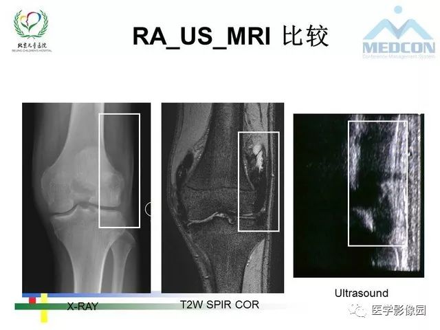 【PPT】儿童血友病性骨关节病的影像评估与策略