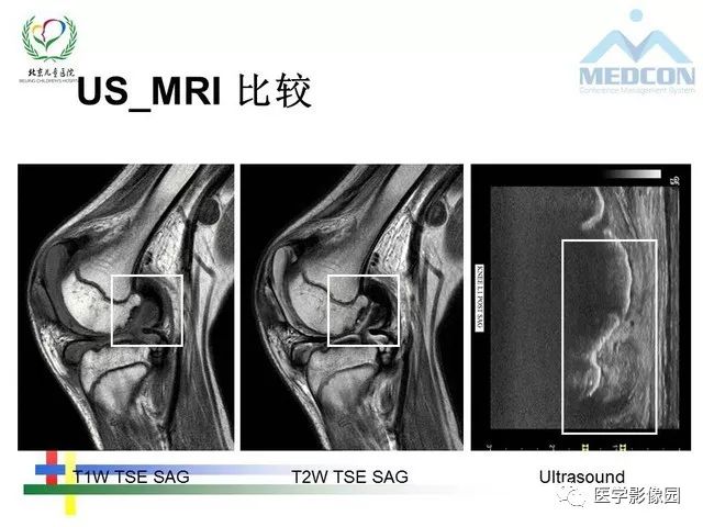 【PPT】儿童血友病性骨关节病的影像评估与策略