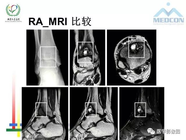 【PPT】儿童血友病性骨关节病的影像评估与策略