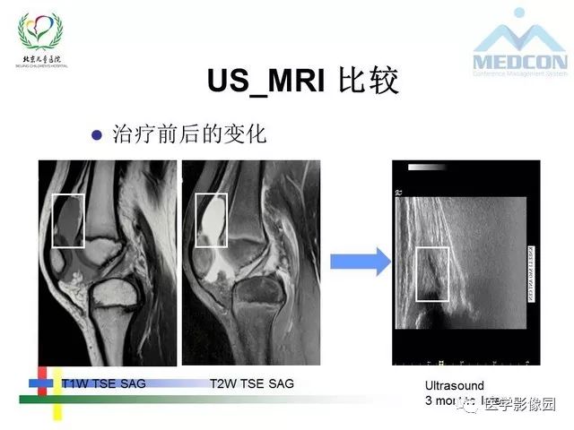 【PPT】儿童血友病性骨关节病的影像评估与策略