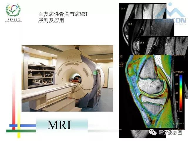 【PPT】儿童血友病性骨关节病的影像评估与策略
