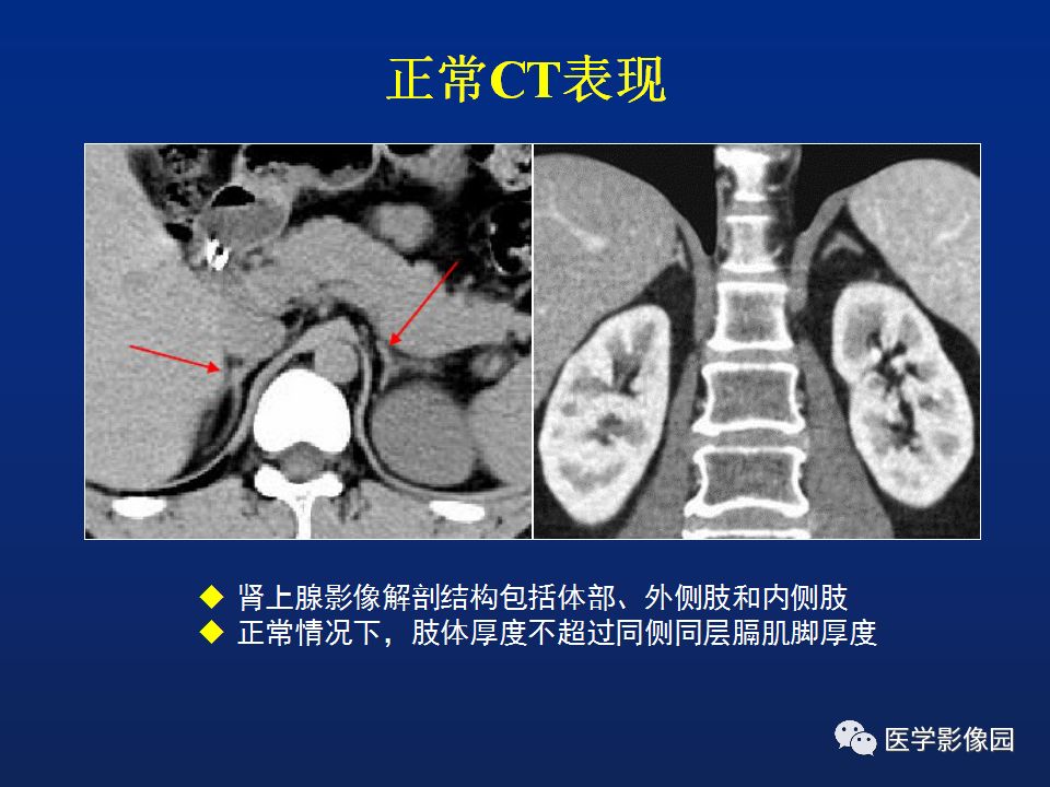 【PPT】肾上腺疾病的影像学表现