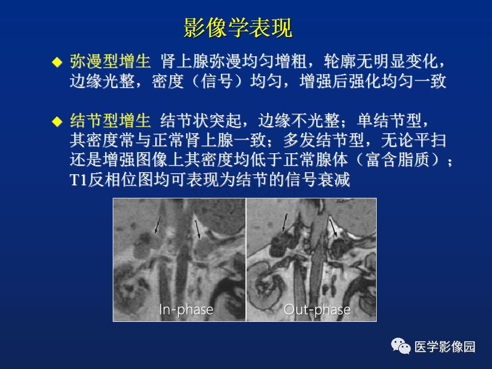 【PPT】肾上腺疾病的影像学表现