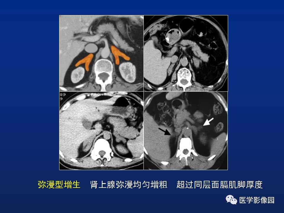 【PPT】肾上腺疾病的影像学表现