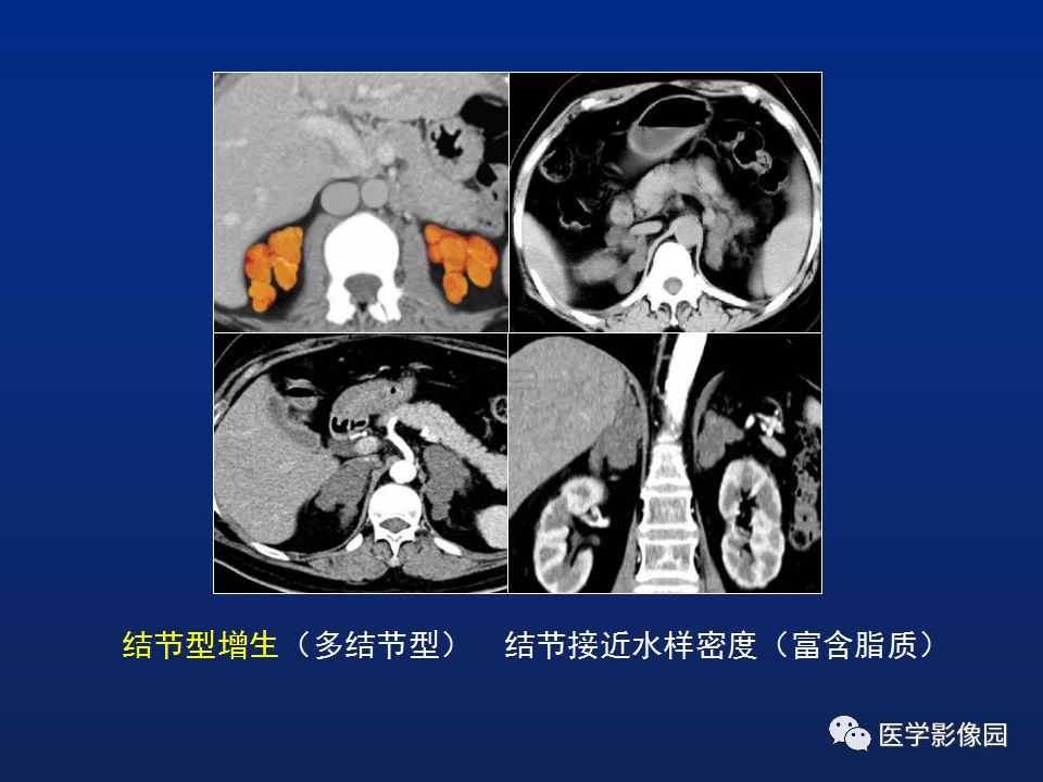 【PPT】肾上腺疾病的影像学表现