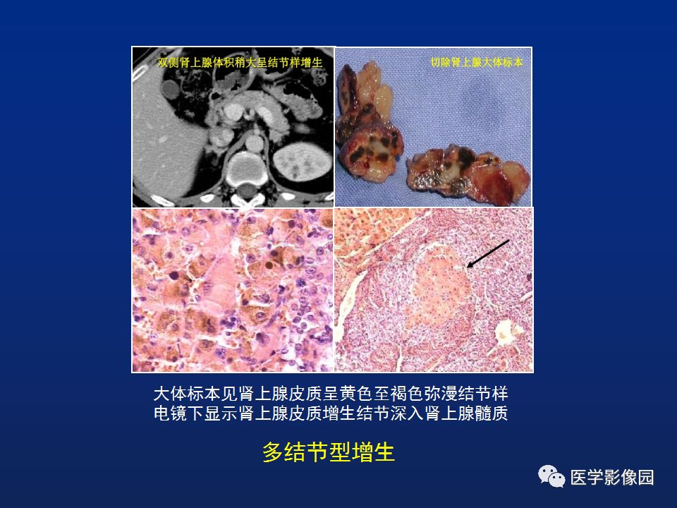 【PPT】肾上腺疾病的影像学表现