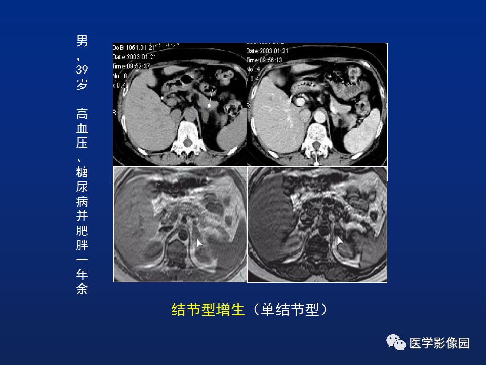 【PPT】肾上腺疾病的影像学表现