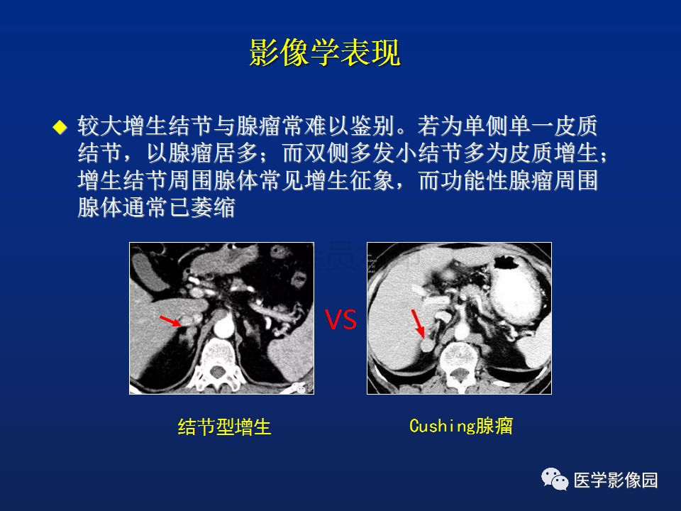 【PPT】肾上腺疾病的影像学表现