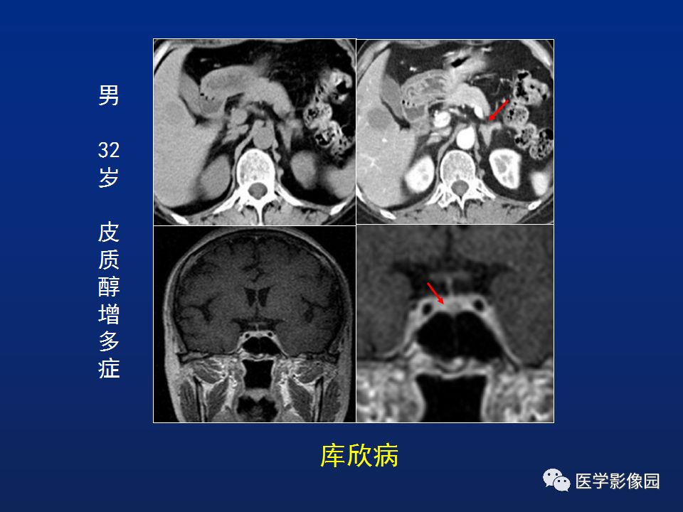【PPT】肾上腺疾病的影像学表现