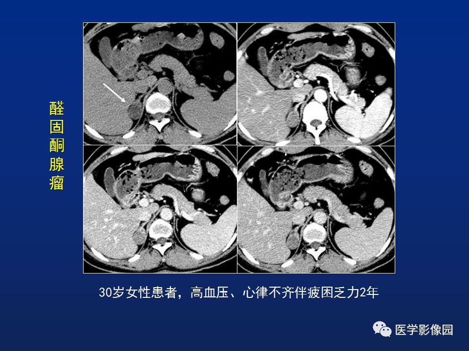 【PPT】肾上腺疾病的影像学表现