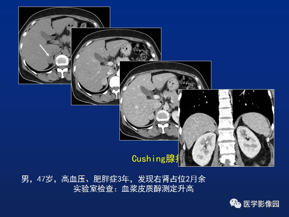 【PPT】肾上腺疾病的影像学表现