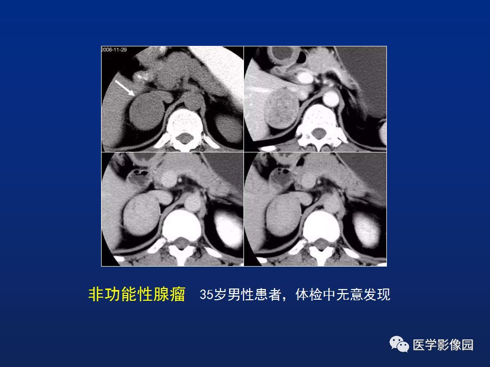 【PPT】肾上腺疾病的影像学表现