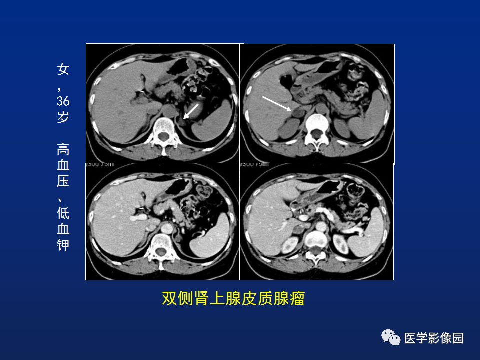 【PPT】肾上腺疾病的影像学表现