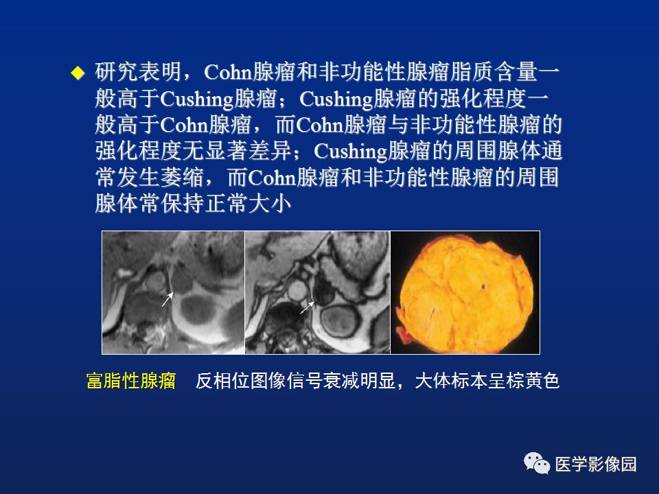 【PPT】肾上腺疾病的影像学表现