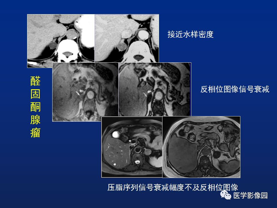 【PPT】肾上腺疾病的影像学表现