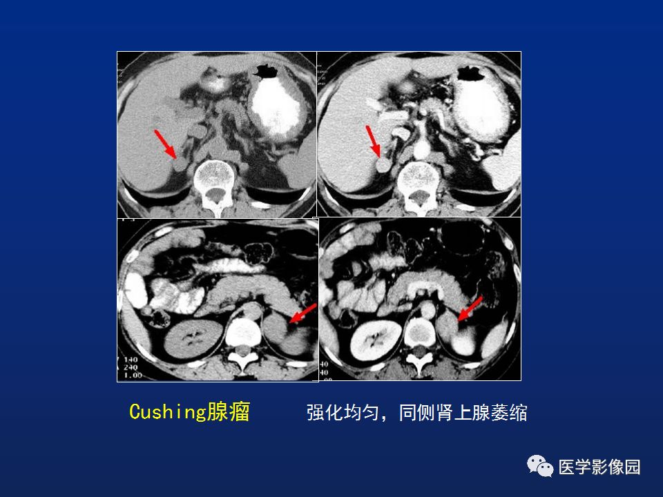 【PPT】肾上腺疾病的影像学表现