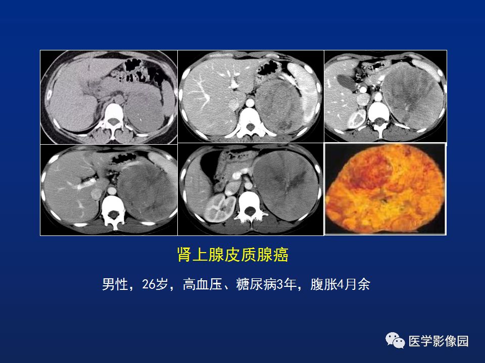 【PPT】肾上腺疾病的影像学表现