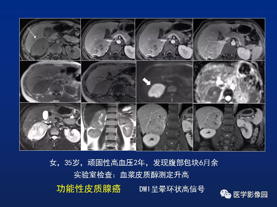 【PPT】肾上腺疾病的影像学表现