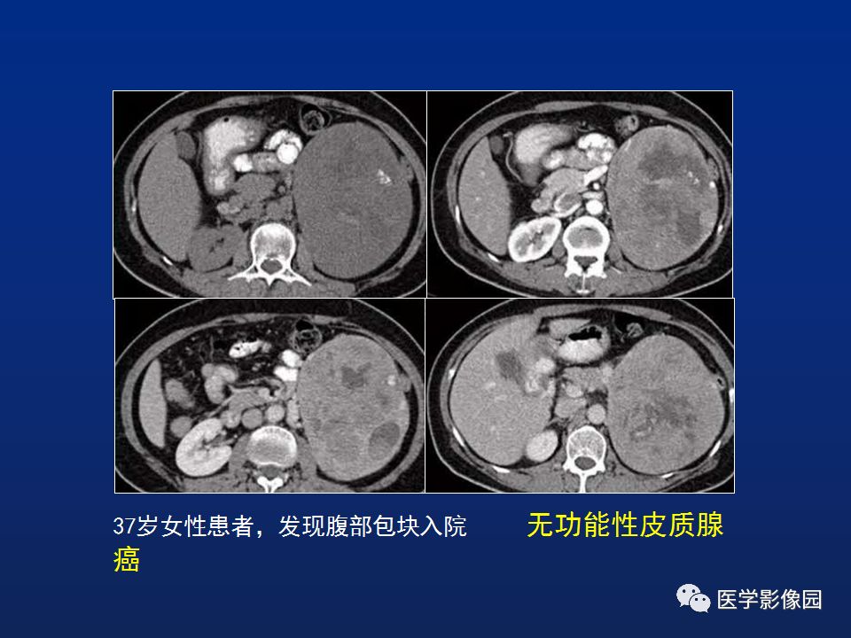 【PPT】肾上腺疾病的影像学表现
