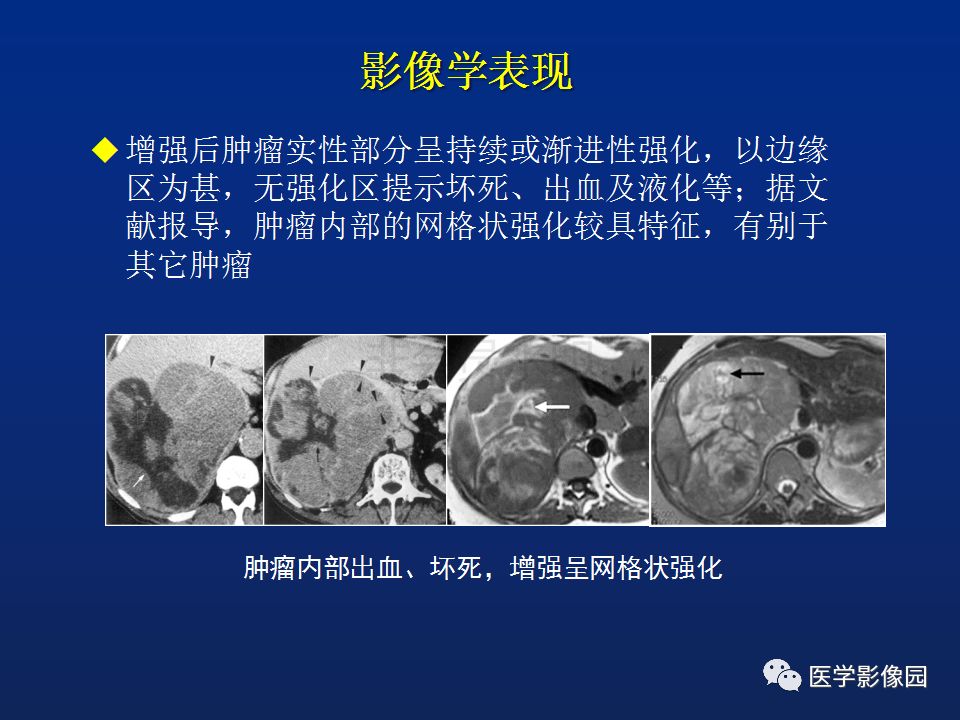 【PPT】肾上腺疾病的影像学表现
