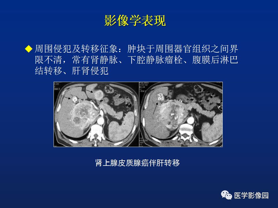 【PPT】肾上腺疾病的影像学表现