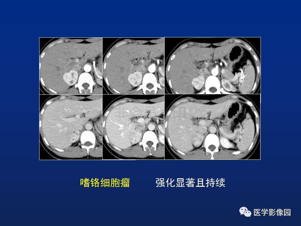 【PPT】肾上腺疾病的影像学表现