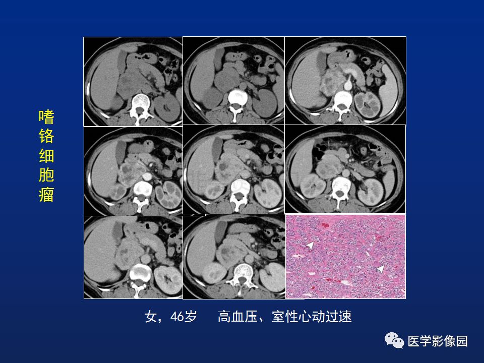【PPT】肾上腺疾病的影像学表现