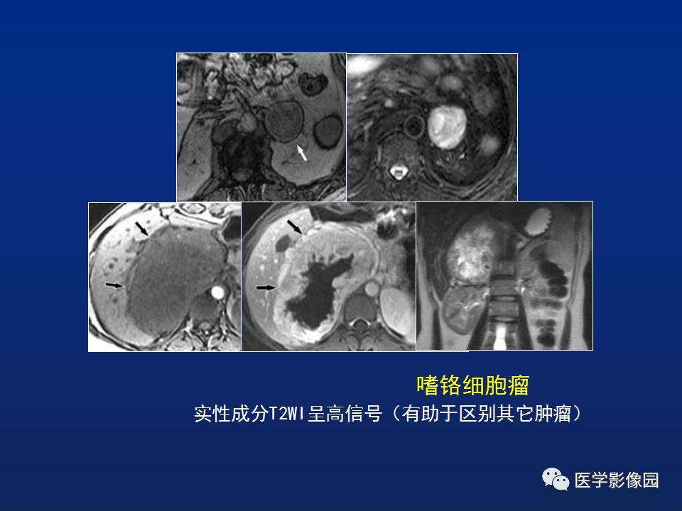 【PPT】肾上腺疾病的影像学表现