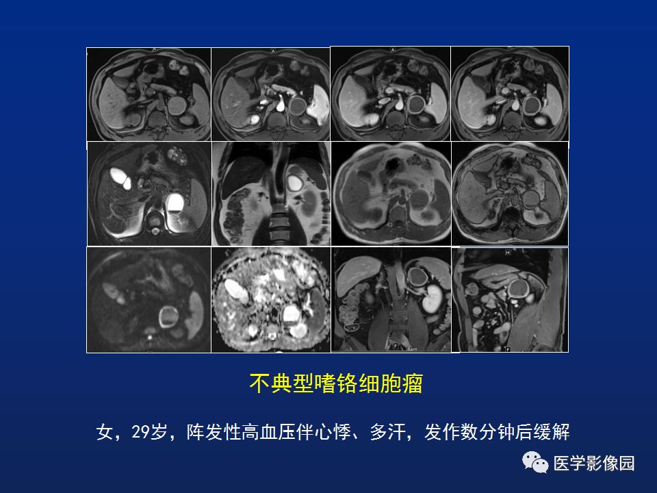 【PPT】肾上腺疾病的影像学表现