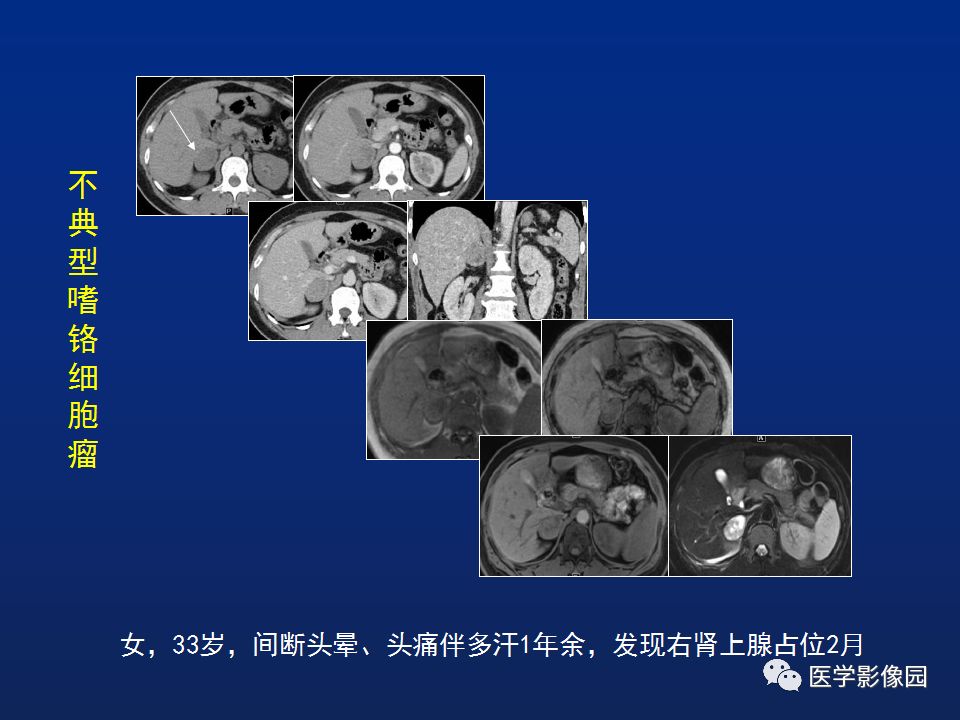 【PPT】肾上腺疾病的影像学表现